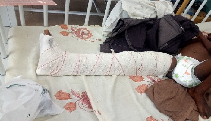 One of the children in bed with fracture on the right leg